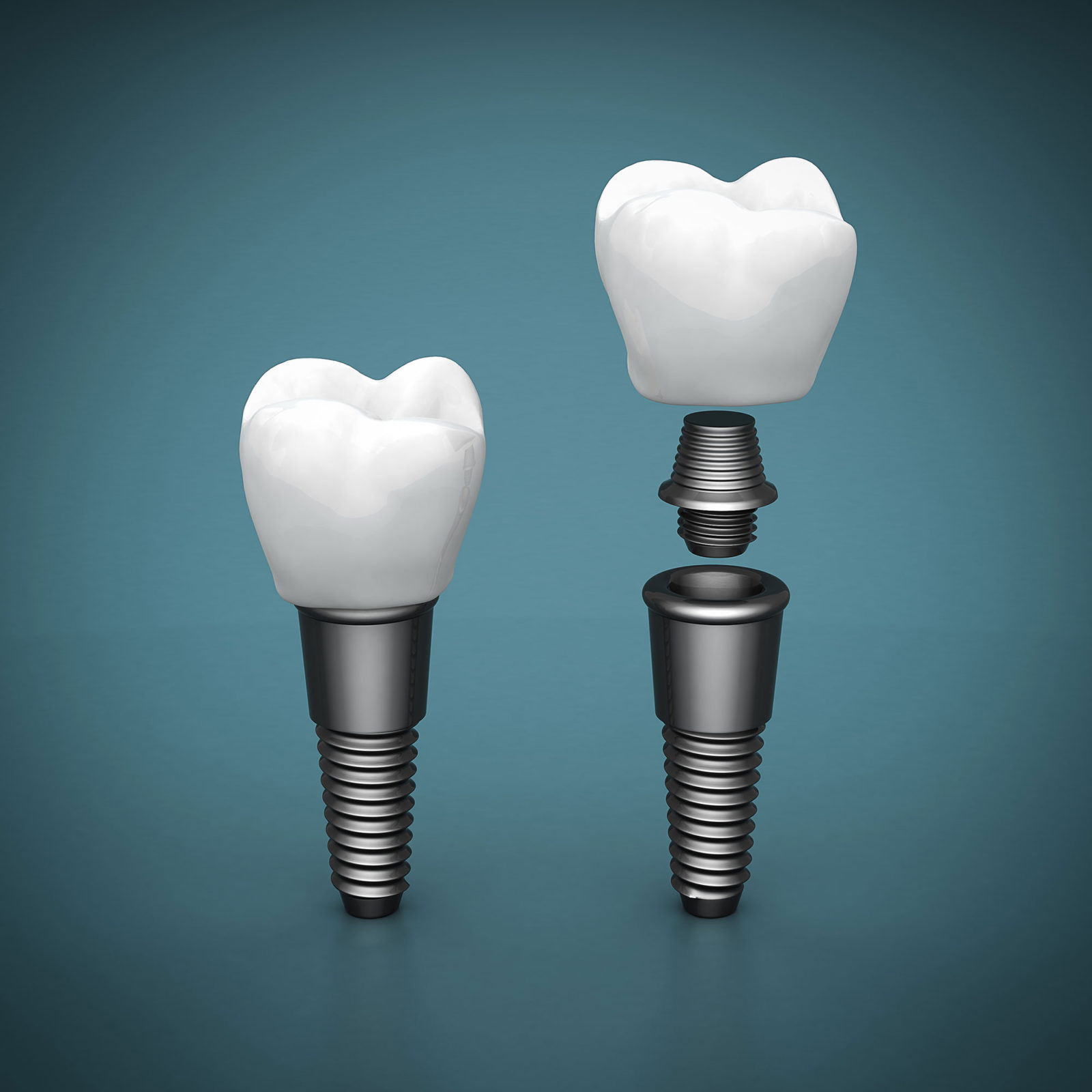 Cirugía E Implantes - Gnatos Clínica Dental