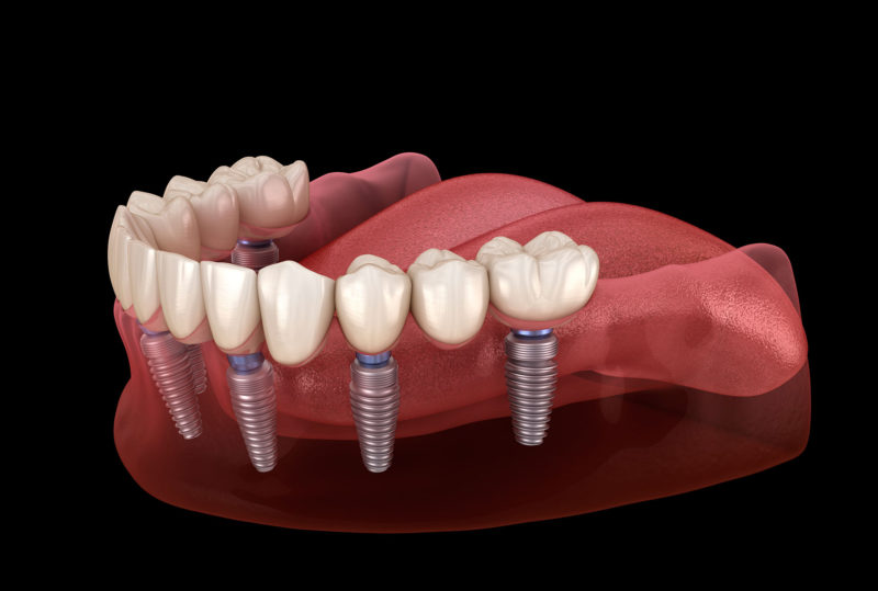 Cirugía E Implantes - Gnatos Clínica Dental